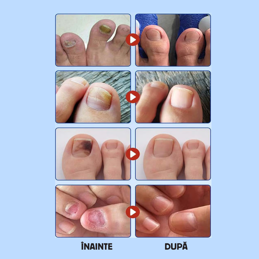 Plasturi pentru tratamentul unghiilor MycoStop