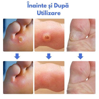 Plasturi adezivi pentru bataturi si calusuri CornPads™